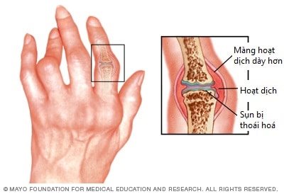 Viêm khớp dạng thấp - Hình ảnh minh họa
